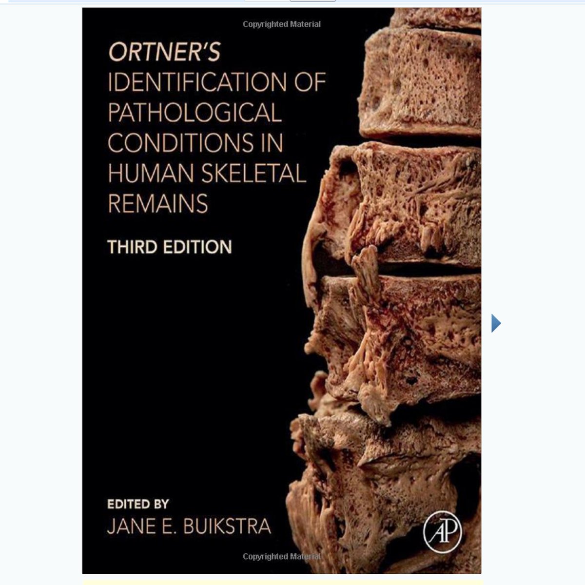 ...but whether these are due to myeloma, metastatic cancer, infection or something else can be difficult to prove. Definitive retrospective diagnosis from ancient bones is tricky. Paleopathology has evolved as a field, but there is still much to learn.  /20End