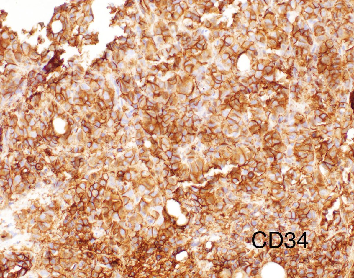 6Patterns's tweet photo. 56 y/o M with 70 pack year smoking hx.  Poorly diff malignancy pos for keratin, CD34 and Focally for TTF-1. Dx or additional work up? @LungPathGuys @howardm19 @smlungpathguy @raghupillappa #pulmpath #carringtoncolbycollection https://t.co/BjPhNjhYC1