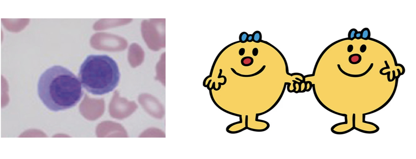 As promised  @mcarpenter1967, a lighthearted thread of 'Mr Men and Little Miss' as haemopoietic cells.First up, we have 'Little Miss Twins' as erythroid progenitors with internuclear bridging. Featured works include MDS and congenital dyserythropoietic anaemia.  https://twitter.com/mcarpenter1967/status/1295628626868789249