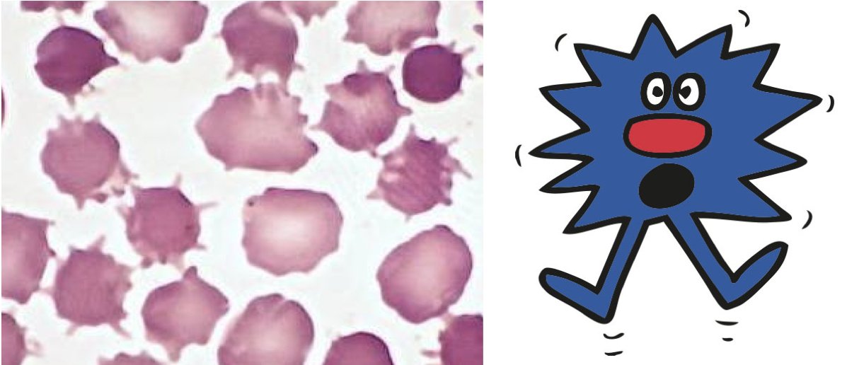 Next, we have 'Mr Sneeze' as an acanthocyte. Best known for his starring role in liver disease.