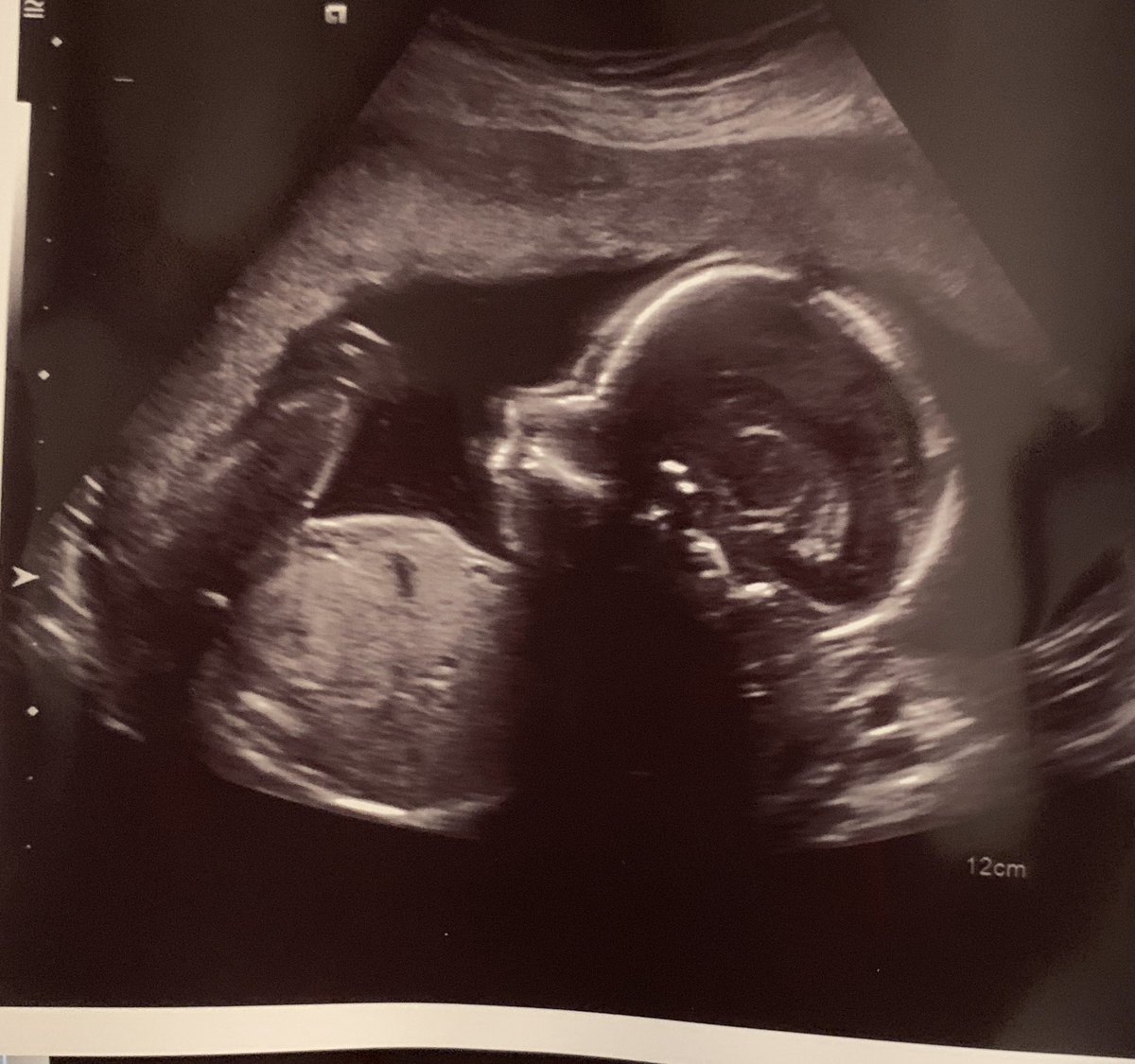 SaraGonzalesTX's tweet photo. This was my baby at 20 weeks. Kamala is advocating for murder. https://t.co/Dsvq9ntmKm