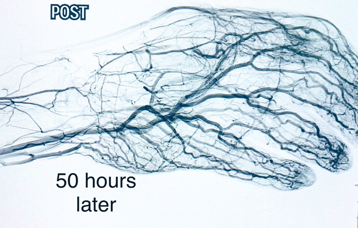 t_intheleadcoat's tweet photo. One more to #COVID19 #ALI series

Young, ischemic left Hand. 
Rx - #CDT @PenVascular CAT6&amp;8
Palpable pulses, no deficits. 
Most of the credit goes to @digisurg and Dr.Park

#MedTwitter #Irad #cardiotwitter #vasctwitter @JVIRmedia @NEJM @JVascSurg @Arabjir @CAIRweb @farkomd https://t.co/lmWJtPkNAx