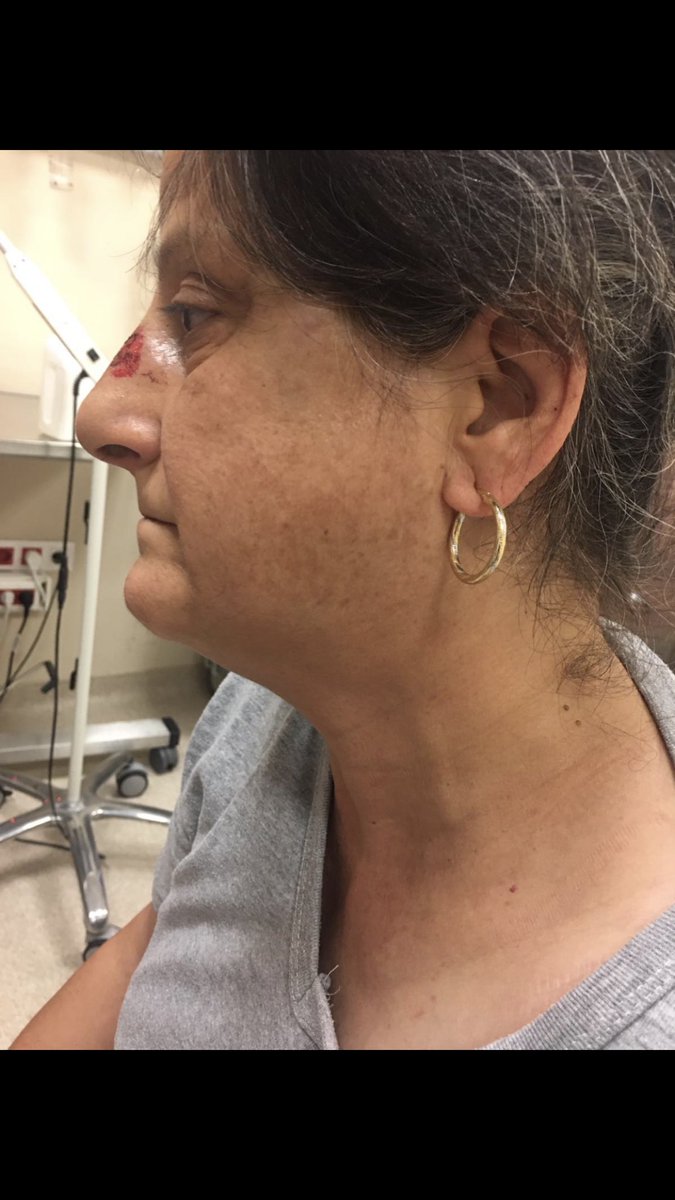 Annem,Ayşe Çengel21.08.20tarihinde abisi tarafından fiziksel ve psikolojik şiddete maruz kalmıştır.Bunun sonucunda burnunda kırıkve vücudunun birçok yerinde morluklar meydana gelmiştir.Annem korkuyor ama biz korkmuyoruz ve korkmayacağız.KADINA ŞİDDETE HAYIR! #ayşeçengeliçinadalet