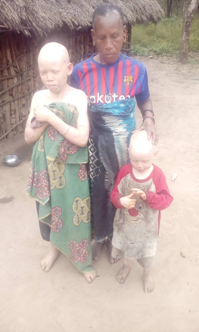YouthShade's tweet photo. Mumbua Mwatei Mnyaka (12) na Tobia Mwaitei Mnyaka (3) Ni watoto wenye  Ulibino. Wanaishi Mkoa wa Manyara kwenye mazingira duni.

Binti mdogo wa kike Mumbua Mwatei aliacha shule kwa sababu ya mazingira kutokuwa rafiki kwa kusoma. Mumbua macho yake yamepoteza nuru ya kuona vizuri. https://t.co/J1VNdiHimf