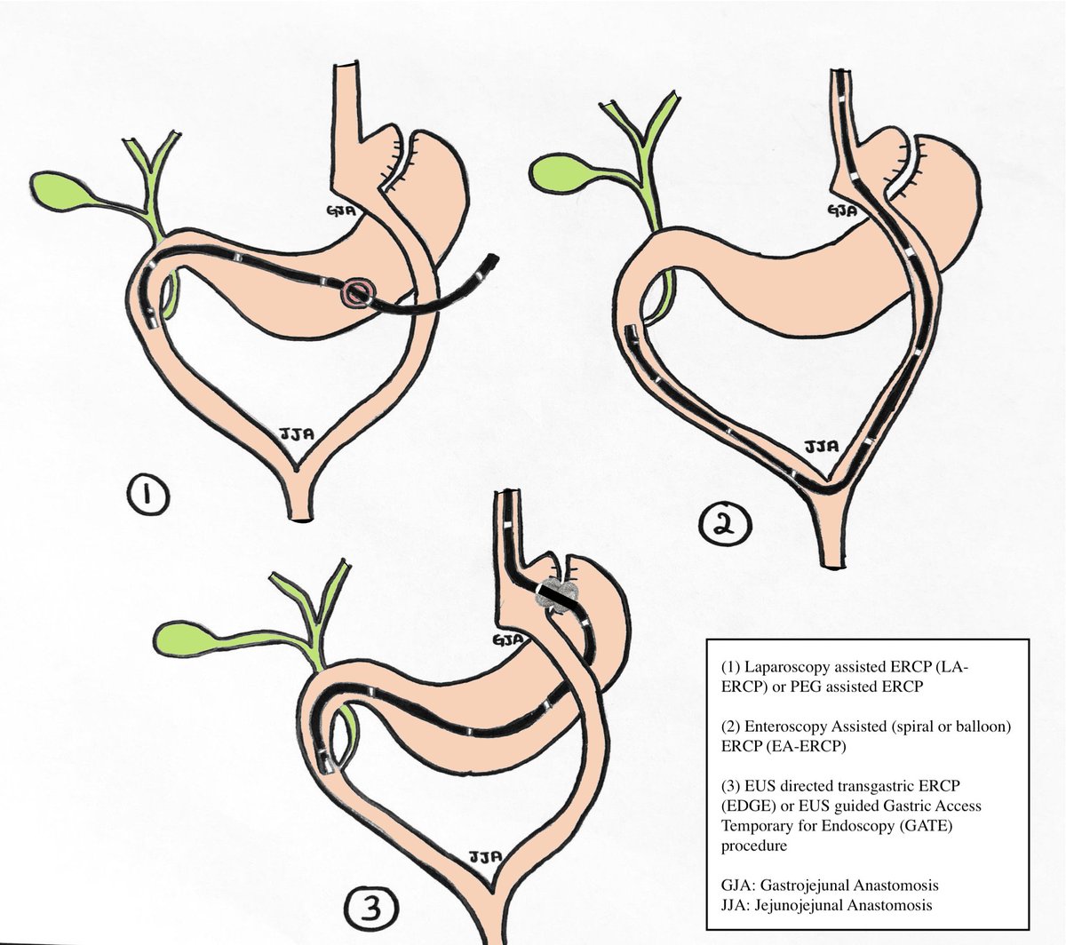 Ahmad N. Bazarbashi أحمد بازارباشي (@ahmadbazarbashi) on Twitter photo How often are you consulted to perform an ERCP on a patient with roux-en-Y gastric bypass ?
Heres a reminder of the endoscopic modalities that can be done (based on resources and endoscopic expertise)
#MedEd <a href="/BrighamGI/">Brigham and Women's GI</a> How often are you consulted to perform an ERCP on a patient with roux-en-Y gastric bypass ?
Heres a reminder of the endoscopic modalities that can be done (based on resources and endoscopic expertise)
#MedEd <a href="/BrighamGI/">Brigham and Women's GI</a>