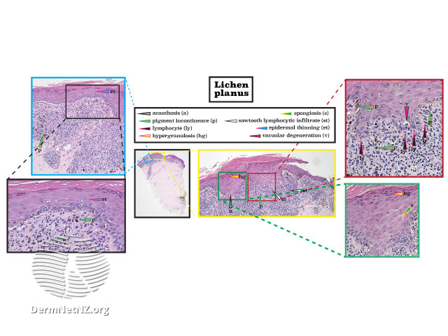 4/That 1st pic is seborrheic dermatitis, & we're seeing greasy SCALE, which is the secondary lesion.To a  #dermatologist, SCALE means there is something going on in the epidermis. This means I'd see epidermal action on biopsy. Check out the  #dermpath example of lichen planus
