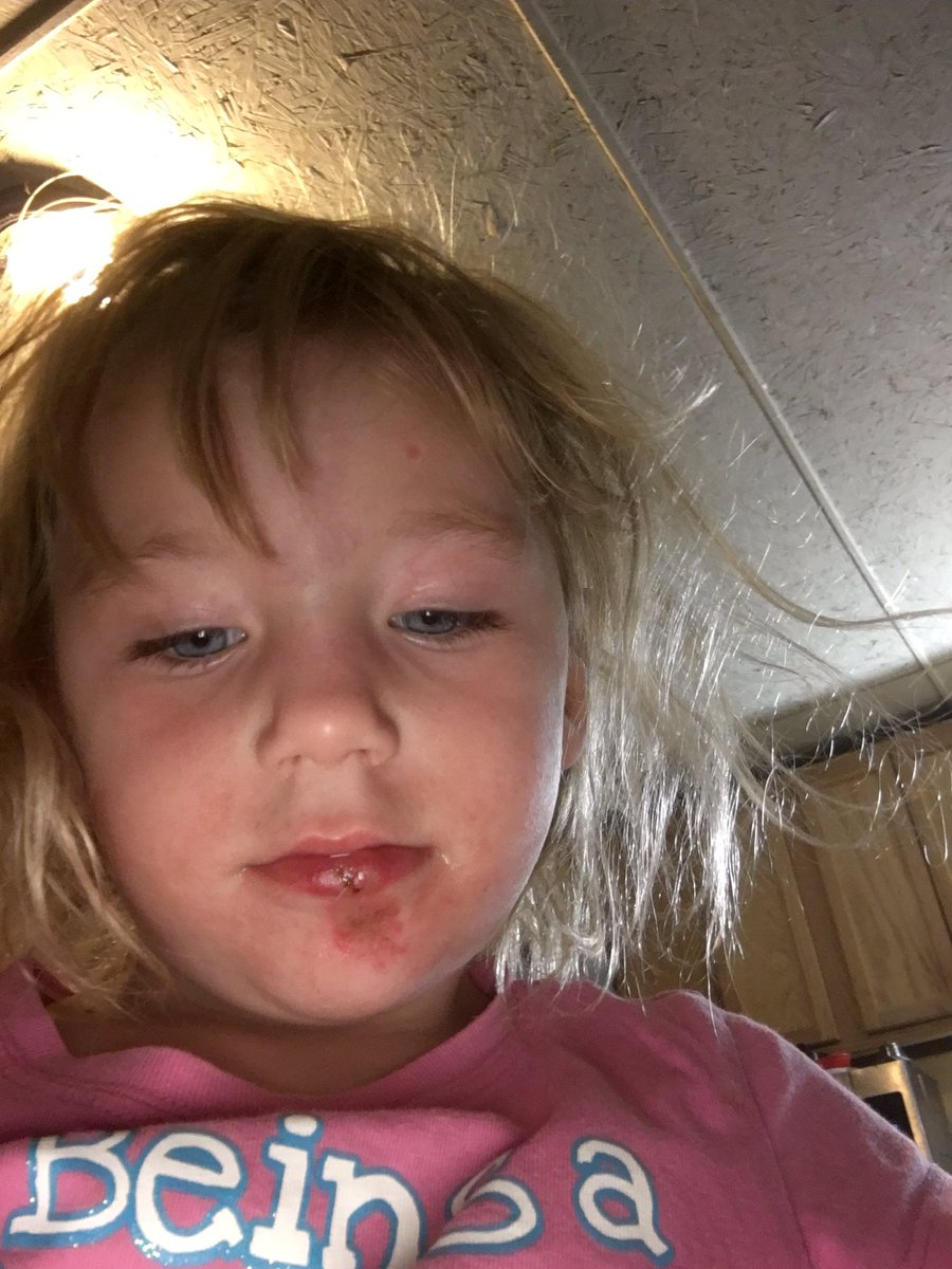 BatShitBatsy's tweet image. Last night my poor baby got hurt. Spent a bit in the er, she had to get a stitch last night. Poor Z