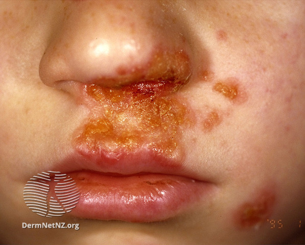 8/The next secondary lesion is CRUST. Unlike scale, crust is usually from a drying of some fluid on the skin. So for that reason, you can get serous crust or hemorrhagic crust (pic1). The color also helps, like in impetigo with honey colored crust (pic2).