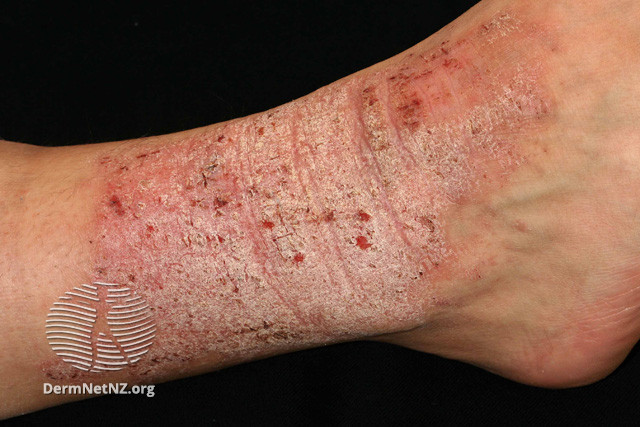 11/Patients with eczema often rub and scratch itchy areas so much that they become LICHENIFIED. Lichenification means you see a plaque of hyper-accentuated skin markings.Notice the difference between lichen simplex chronicus on lighter and darker skin.