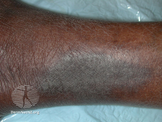 11/Patients with eczema often rub and scratch itchy areas so much that they become LICHENIFIED. Lichenification means you see a plaque of hyper-accentuated skin markings.Notice the difference between lichen simplex chronicus on lighter and darker skin.