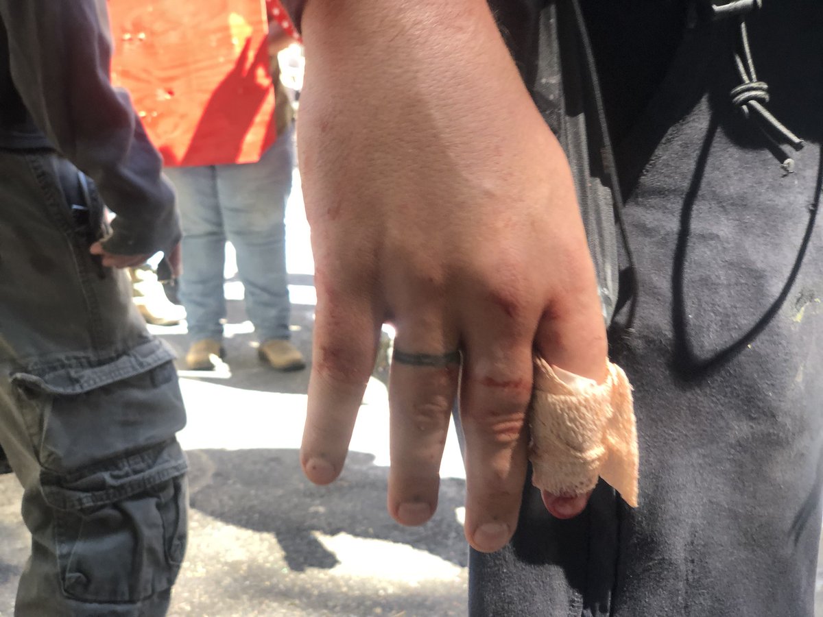Robert says his hand is broken. It’s currently bandaged up and he is still out doing his job.