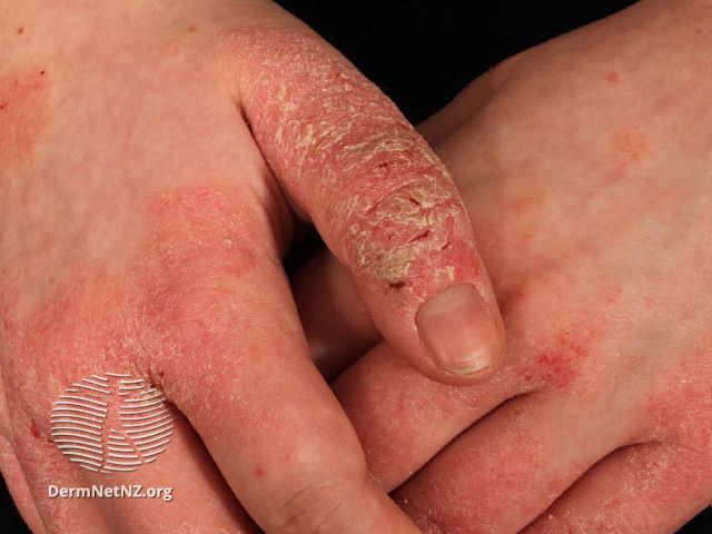 14/One last point: you can have multiple "changes" or secondary lesions for one primary lesion.Check out this picture of hand eczema. There are CRUSTY plaques with SCALE and FISSURES (which just means linear erosions). That's three descriptors for the primary plaque!