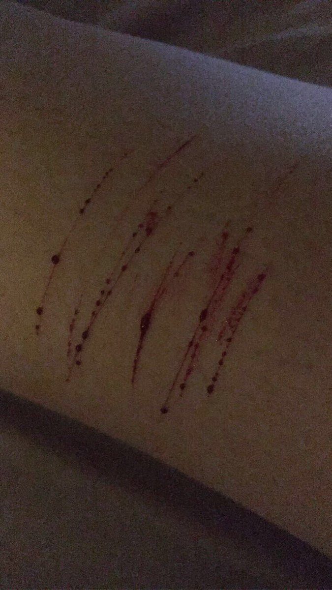 thunderxsid's tweet photo. tw// self harm/ blood
-
-
-
-
-
-
-
-
-
-
-
-
-
-
-
-
-
so... i’m kinda in love with these ngl also sorry the second picture is such bad quality my lighting is super bad lmao #shtwt #selfharm #proselfharm (not really just a tag) https://t.co/gsOCQknCYz