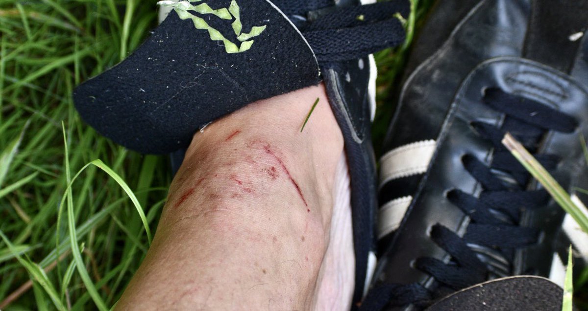Yeah, I don’t know what the fuck kind of grass that was but it appears to be forged of razor-sharp tungsten or some other weapons-grade alloy.Sliced me to ribbons.I very much did not enjoy Field One Should Not Cross in Shorts.12/