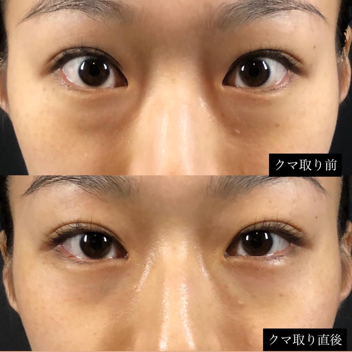 Rejuva 表参道レジュバメディカルクリニック 肌管理 膣管理 アートメイク エステ 美容点滴 目の下のクマ取り たるみ取り 症例 レジュバで大変人気な施術です 瞼の裏から脂肪を取るだけで非常にスッキリします 膨らみが出てきたら早めに取りま Rejuva 表参道レジュバメディカルクリニック 肌管理 膣管理 アートメイク エステ 美容点滴 目の下のクマ取り たるみ取り 症例 レジュバで大変人気な施術です 瞼の裏から脂肪を取るだけで非常にスッキリします 膨らみが出てきたら早めに取りま