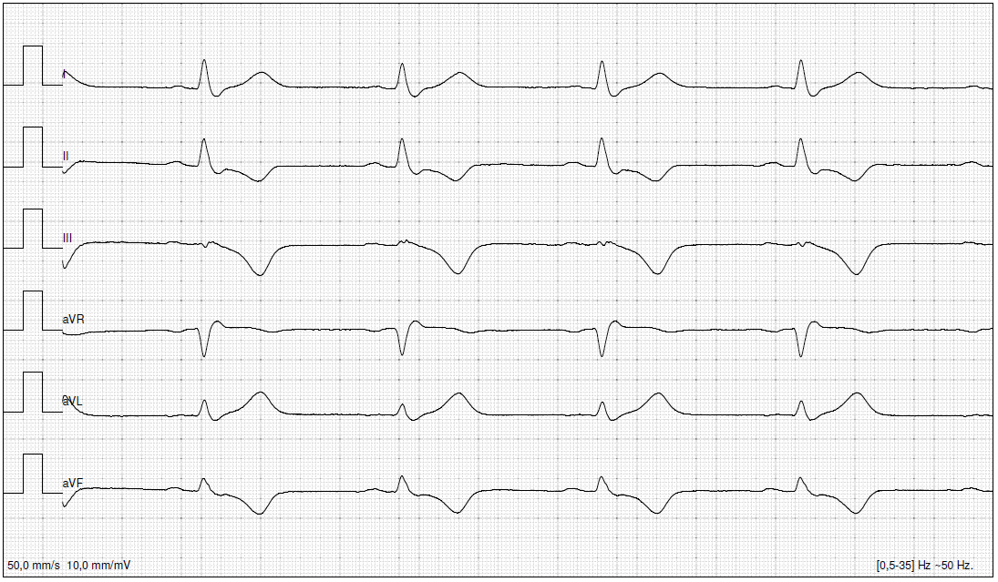 Arrhythmogenic right ventricular cardiomyopathy (ARVC) @lpbadano  @DavidWienerMD  @iamritu  @denisamuraru  @leylaelifsade  @drzgezdentok1  @KemalogluOz  @ImagenCardiaca  @mswami001  @DonalErwan  @drahmedmohsen85  @NMerke  @StefanoNistri  @PeroneFrancesco  @DrJayMohan  @chiarabd  @ecocardio_cl