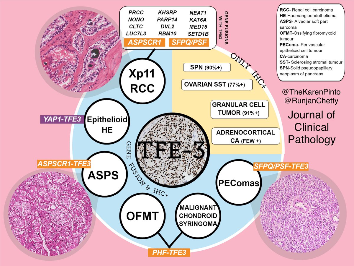 Karen Pinto Dnb Frcpath All You Need To Know About Tfe3 Gene Sometimes Called Tfea Image 2 Tumours With Tfe3 Gene Fusions Ihc As Well As Those Which Karen Pinto Dnb Frcpath All You Need To Know About Tfe3 Gene Sometimes Called Tfea Image 2 Tumours With Tfe3 Gene Fusions Ihc As Well As Those Which