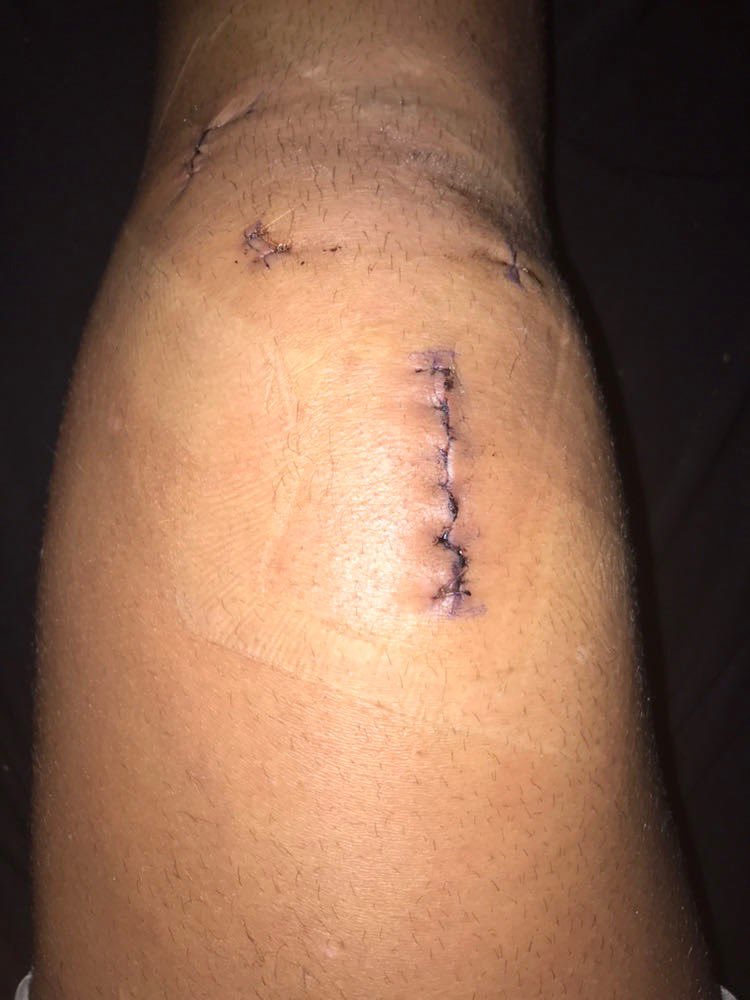 Petite photo de mon genou après l’opération. 