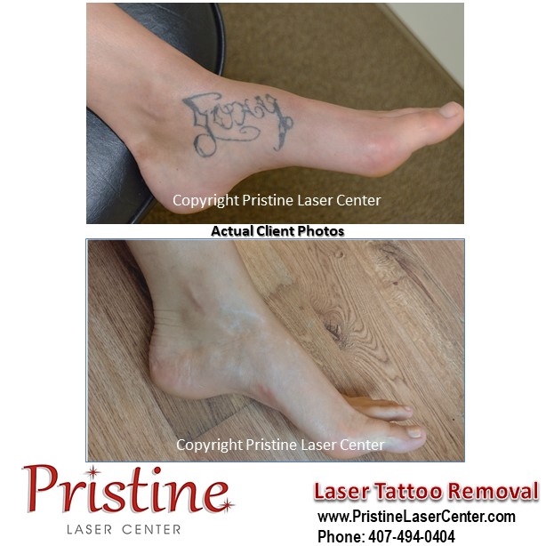 Pristine Laser on Twitter: Pristine Laser on Twitter: