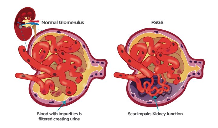 Vocabulary word of the day: Glomeruli sclerosis.  Glomeruli thicken as a result of protein glycosylation = glycated proteins deposit in the glomeruli = renal plaguing = scarring = ESRD. Essentially atherosclerosis of the kidneys. Cause: SAD diet=T2DM. Cure = #LCHF. Any questions?