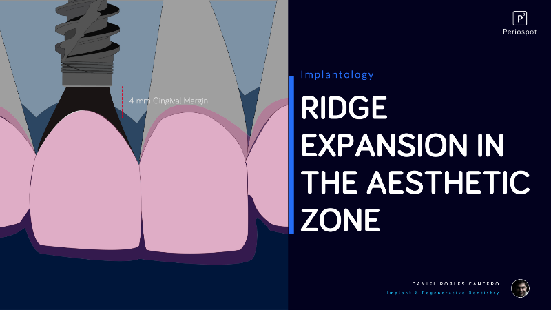 PerioSpot's tweet image. Ridge Expansion in the Aesthetic Zone? Yes, we have it 😍 - mailchi.mp/695d32c4e63d/r…