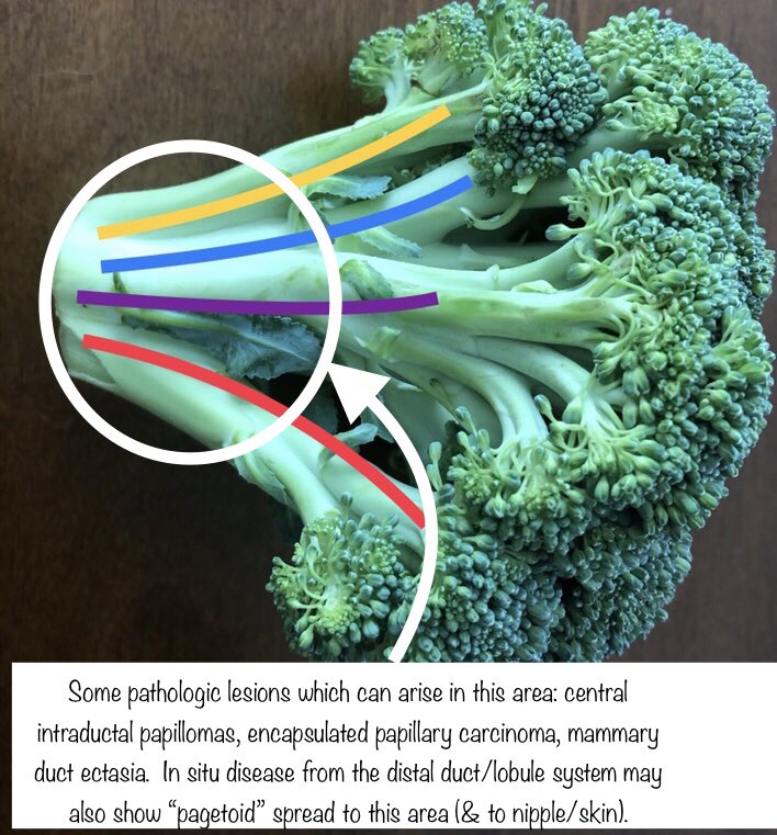 2. A cruciferous conception of the breast ductal/lobular system:Each large branch (colored lines), along with its ramifications, defines a breast lobe. Conceptually important, but not easily identifiable anatomically.