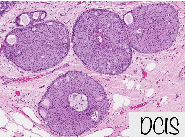 3. Cut surface:Pics taken from a fantastic recent review on DCIS, read it, you’ll be a better breast pathologist.Full text: https://www.nature.com/articles/s41379-019-0204-1