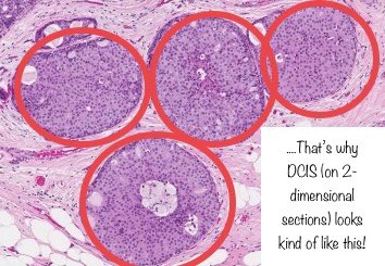 3. Cut surface:Pics taken from a fantastic recent review on DCIS, read it, you’ll be a better breast pathologist.Full text: https://www.nature.com/articles/s41379-019-0204-1