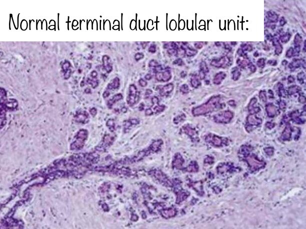 4. Terminal ductular lobular unit: the end part of the broccoli. Picture the lobule as the little green nub at the very end.TDLU pic: https://www.google.com/amp/s/slideplayer.com/amp/5988133/