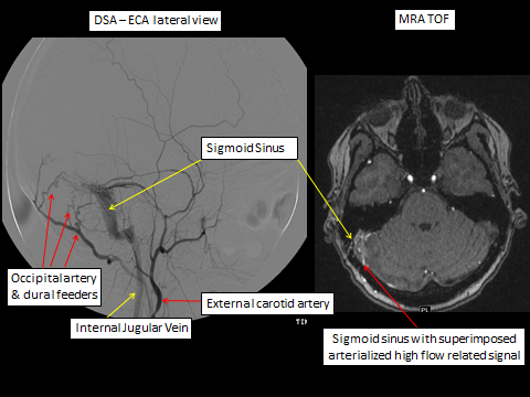 Hammerdongle's tweet photo. Dural Arteriovenous Fistula

Findings: Serpiginous irregular hypertrophied occipital-dural feeding arteries with early filling of the sigmoid sinus and IJV.

#FOAMed #FOAMrad #radres #NeuroRad #radiology #Neurology https://t.co/sVqSc0mHo5