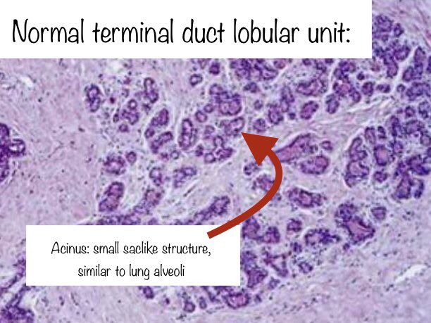 5. TDLU: where most neoplasia happens. Note that the broccoli doesn’t have an equivalent for the acinus... but looks cool under a microscope.Pics from: http://google.com/amp/s/www.pint …Thanks all!