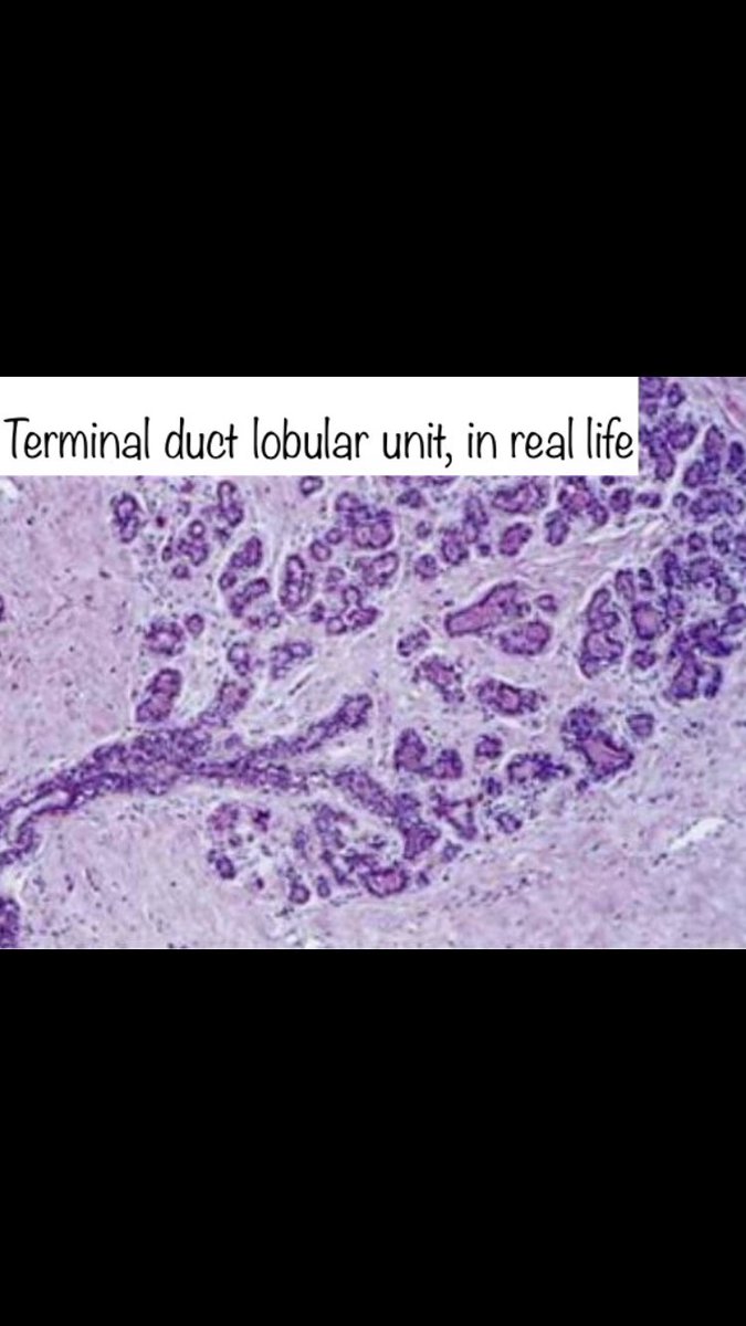 5. TDLU: where most neoplasia happens. Note that the broccoli doesn’t have an equivalent for the acinus... but looks cool under a microscope.Pics from: http://google.com/amp/s/www.pint …Thanks all!