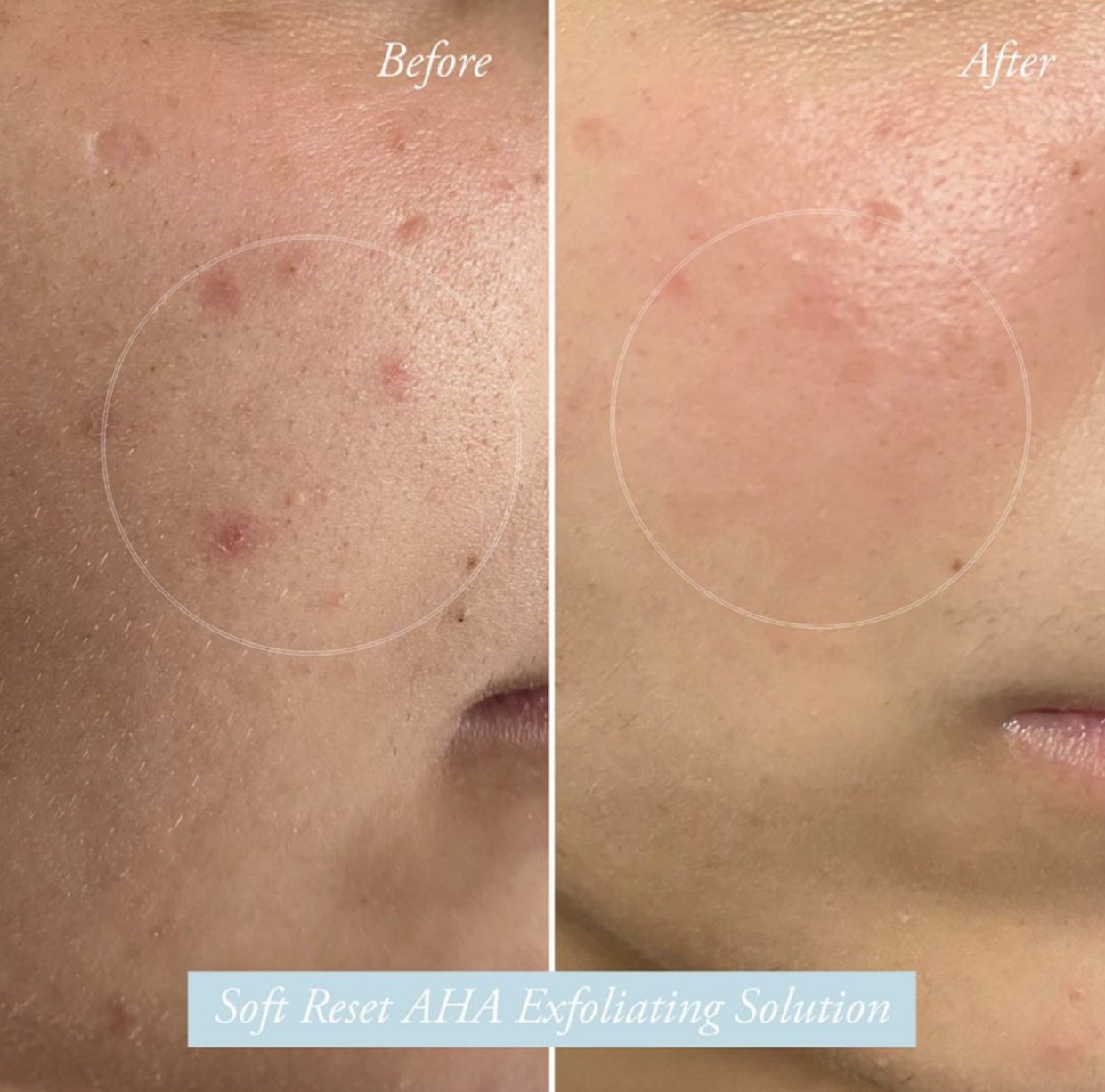 summer fridays soft reset aha exfoliating solution