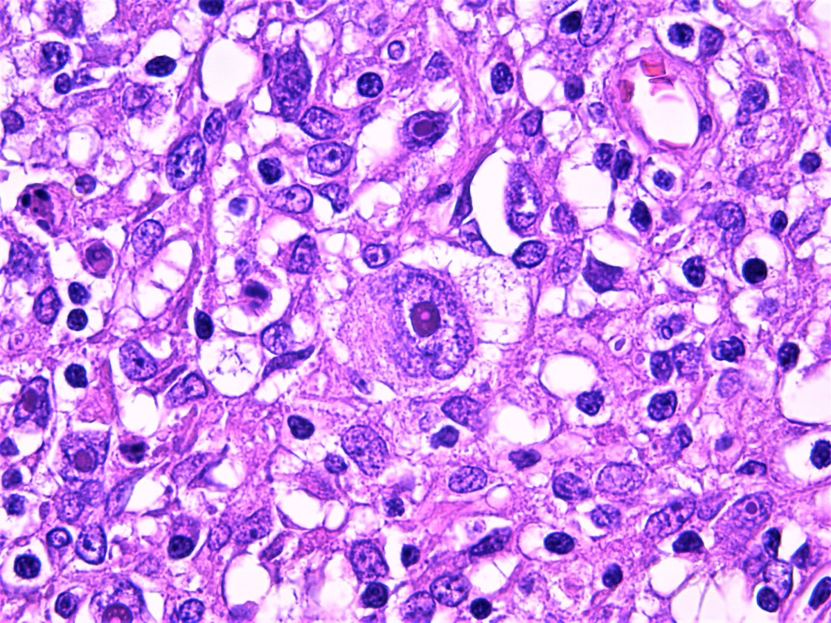 Classic Hodgkin lymphoma. Stamp Papanicolaou and HE. #Pathology #Pathologist #Hemepath