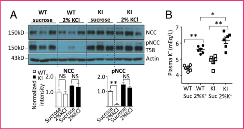 Missense mutations in WNK4=NCC & DCT hyperplasia (as seen w/diuretic resistance!)Cl- insensitive WNK4develop HTN andNCC activity WNK1 autoactivation is inhibited by Cl- WithCl- WNK1 autophosphorylates and becomes activeSo Cl-=WNK1 & WNK4= NCC