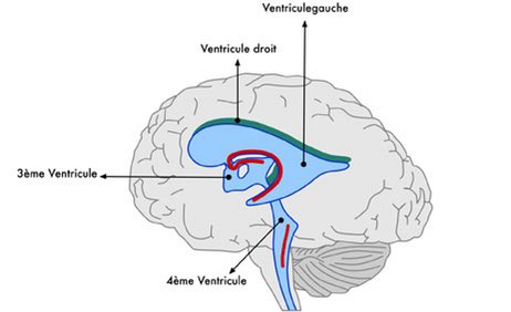 Il dit que n'y a rien d’anormal et pas assez pour s’inquiéter. C’est là que je ne remercierais jamais assez mon père d’avoir insisté pour un scanner du cerveau : verdict j’ai une tumeur au cerveau, 4ème ventricule (la tumeur bloquait le sang qui venait au cerveau)(4è ventricule)