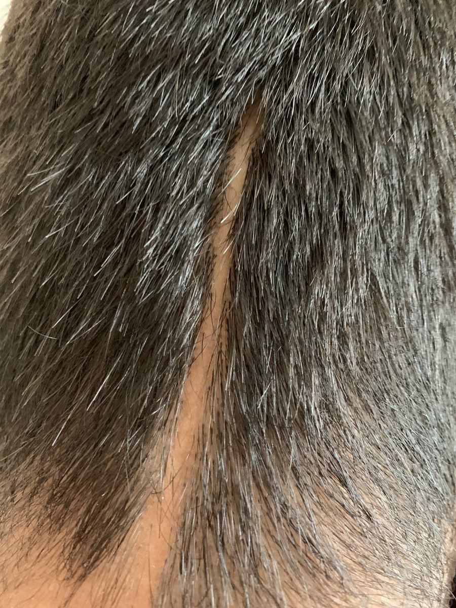 Aujourd’hui je dois passer mon dernier contrôle de routine (pour voir s'il reste une trace de la tumeur) on vois toujours la cicatrice qui restera à vie derrière ma tête, je vous montre une photo que je vais prendre . (juger pas les contours, mes cheveux ne repoussent plus)
