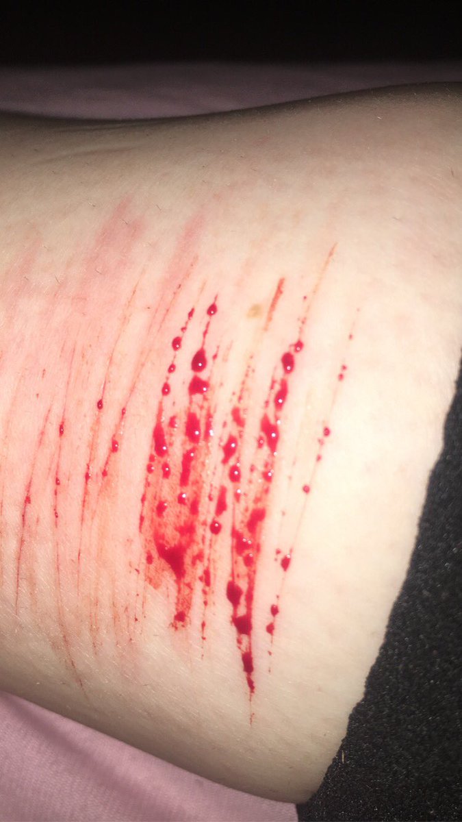 thunderxsid's tweet photo. tw// self harm
-
-
-
-
-
so i know they look like shit shush but i mean...yk also my other leg is so full oml but i was too lazy to make a picture of that one so here. #shtwt #selfharm #proselfharm (not really just a tag) https://t.co/Lb2CjxQxPw