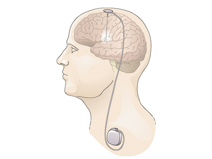 1/ Did you know that  #neuralimplants have been used to treat severe brain disorders for 50+ years now?! Maybe not new but definitely exciting! [1]A (timely)  #firstthread on where we are, where we're going, and how to move forward responsibly.img:  https://www.ninds.nih.gov/About-NINDS/Impact/NINDS-Contributions-Approved-Therapies/DBS