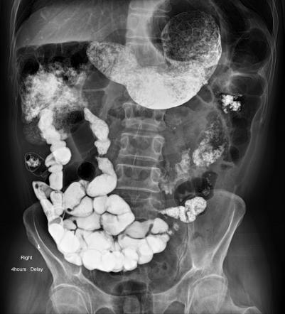 рентген с барием спб. скопия желудка с барием. рентгеноскопия желудка с барием норма. злокачественная опухоль желудка рентген. безоар толстого кишечника рентген.