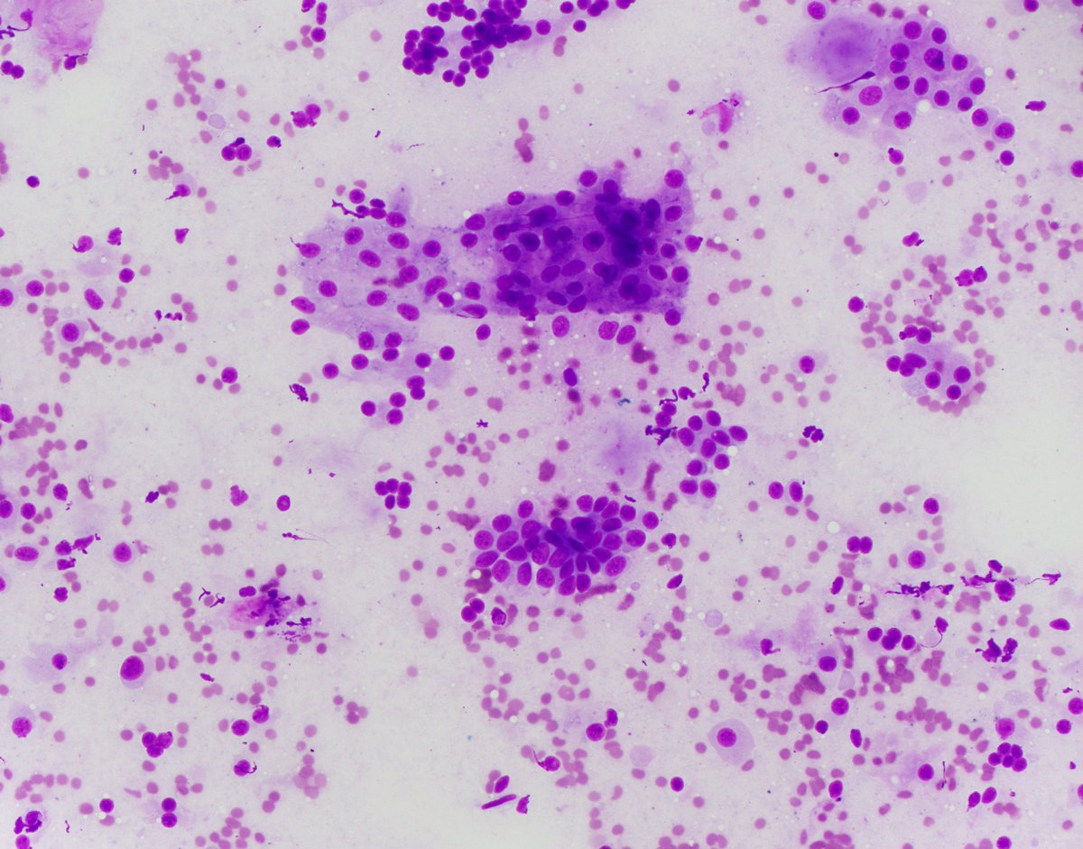 HubertLauMD's tweet image. #CytoPath/#FNApath 🧩
Organ? Diagnosis?
