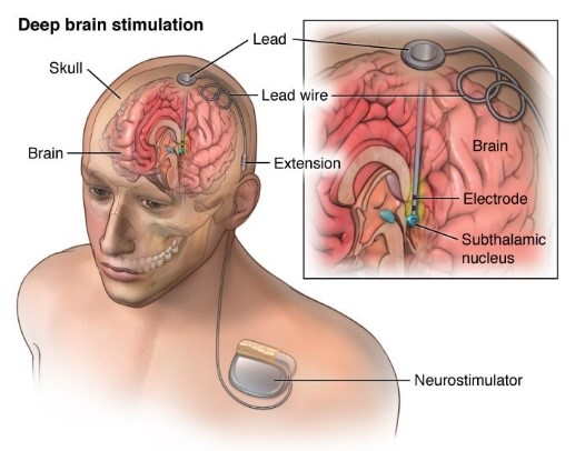 2/ There are over 160,000 people walking around with Deep Brain Stimulation (DBS) devices that treat symptoms ranging from uncontrollable tremors to severe depression! DBS involves  #neurosurgery to implant electrodes into specific parts of the brain. img:  https://www.aans.org/en/Patients/Neurosurgical-Conditions-and-Treatments/Deep-Brain-Stimulation