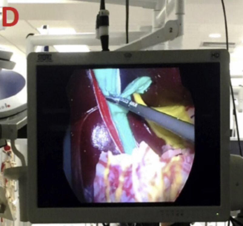 Laparoscopic common bile duct exploration simulation: Laparoscopic box simulator, LCBDE model and kit! How to do it and Early analysis! #SoMe4Surgery #MedTwitter @herbchen @pferrada1 @Cirbosque @MISIRG1 @julianvarascom @juliomayol @SWexner @almagoch