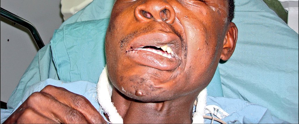 Tetanus is caused by a germ called Clostridium tetani.This germ produces a dangerous  #toxin that makes your muscles painfully contract on their own & become rigid. This man had neck stiffness & lockjaw from tetanus;