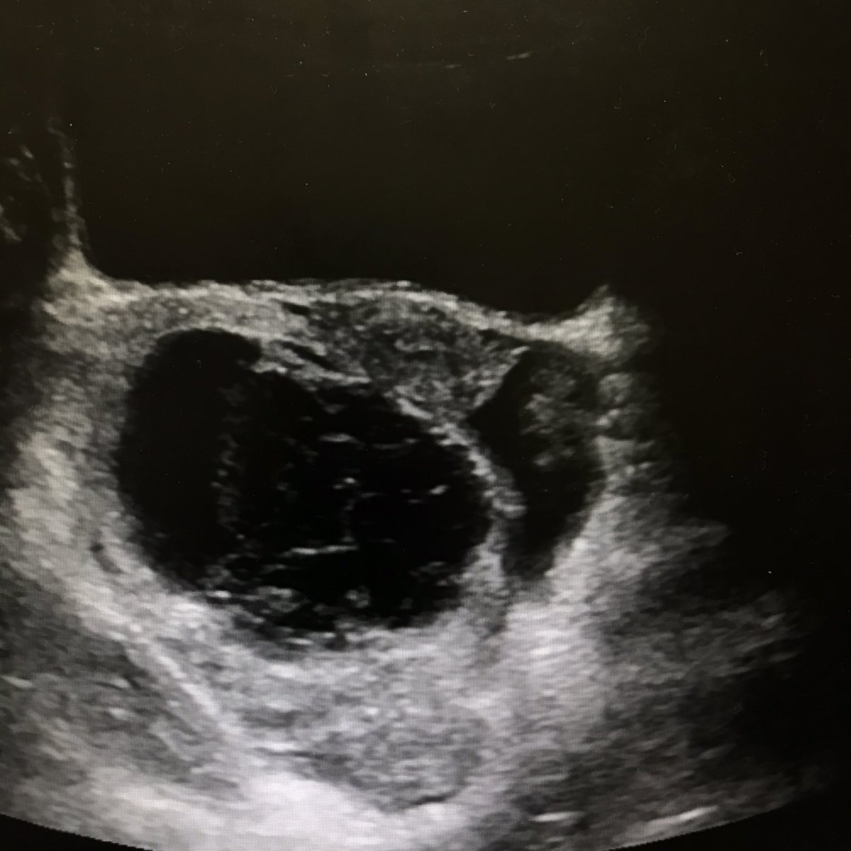 Enlarged right ovary with complex (hemorrhagic cyst) and absence of color and spectral Doppler flow. Also shown is the normal Left ovary.