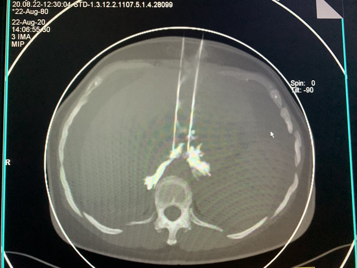 SUHAIBa2t's tweet photo. Anterior approach (celiac nerve block) https://t.co/dRU8I3cCJY