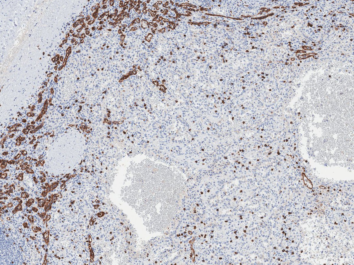 So we have some atypia, but no necrosis, and rare (if any) mitoses. Probably not angiosarc. Here's a CD8 to show the replacement of normal splenic pulp.