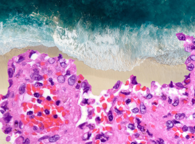 Final diagnosis? Littoral cell angioma. Rare benign splenic vascular neoplasm thought to arise from red pulp sinus lining cells. Littoral means "relating to or situated on the shore of the sea or lake.As a surfer, I think that's just awesome.
