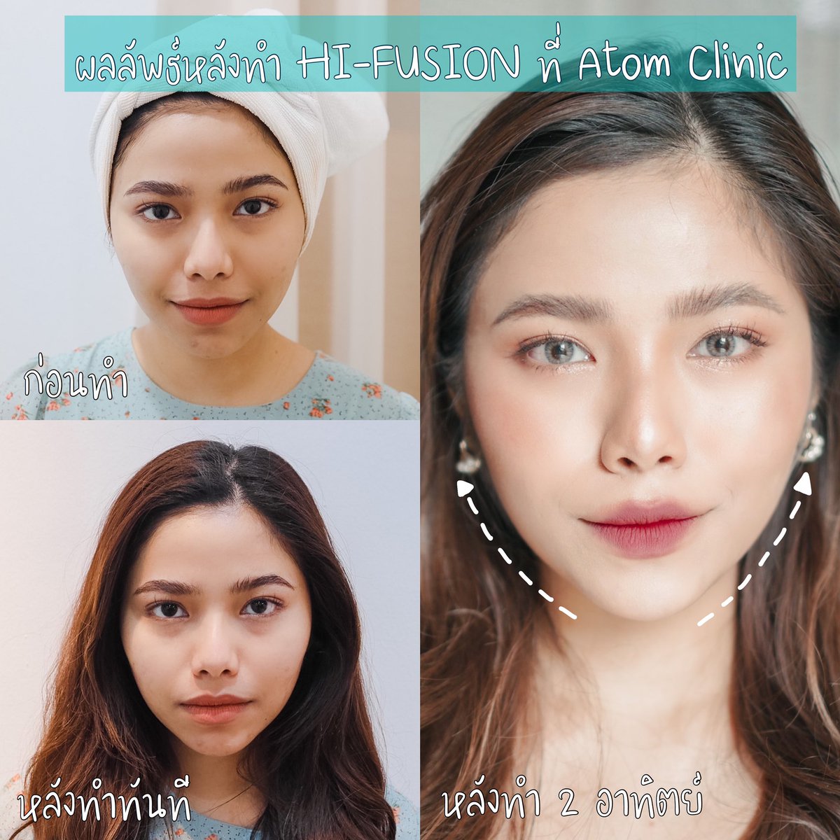 aebonglife's tweet photo. นี่แหนะเนอะพลังของไฮฟู เอไปทำโปรแกรม Hi-Fusion ที่ @atomclinic มา 2 อาทิตย์ หน้ายกมาก ร่องแก้มก็ตื้นขึ้นมากๆ ตอนทำไม่เจ็บนะ โปะยาชาแล้วคุณหมอก็ยิงแบบเน้นๆให้เลยโดยเฉพาะร้องแก้มเอขอหมมอให้จัดเต็มเลย ร่องหาย หน้ายกตอบไปเยอะมาก ผิวก็ฟูขึ้นด้วย #HowtoPerfect #ไว้รีวิวห้ามขายของโว้ยย https://t.co/sNjqJsGLs5