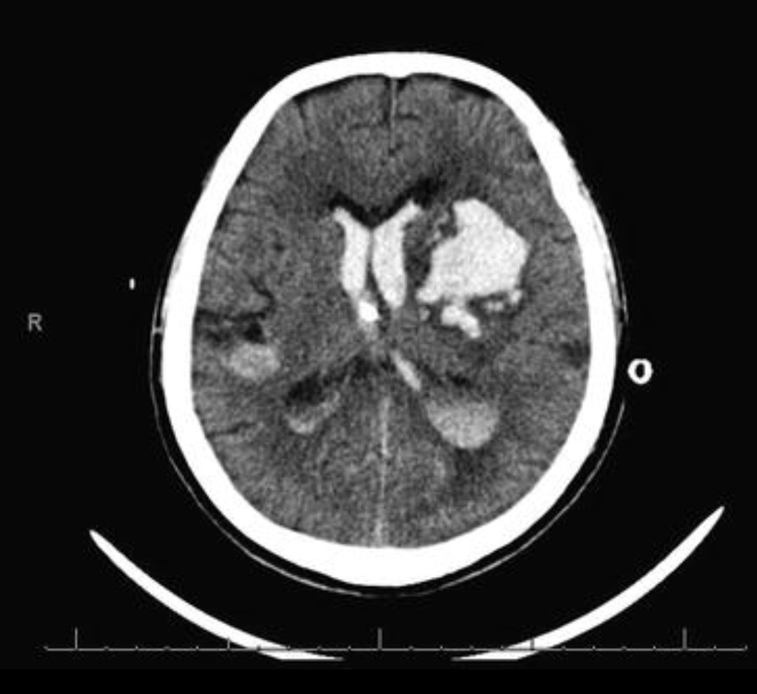 - intracerebral hemorrhageمن اسمه هتلاقى نزيف فى وسط نسيج المخ نفسه أو فى ال ventricles و ملوش شكل محددزى الصوره دى